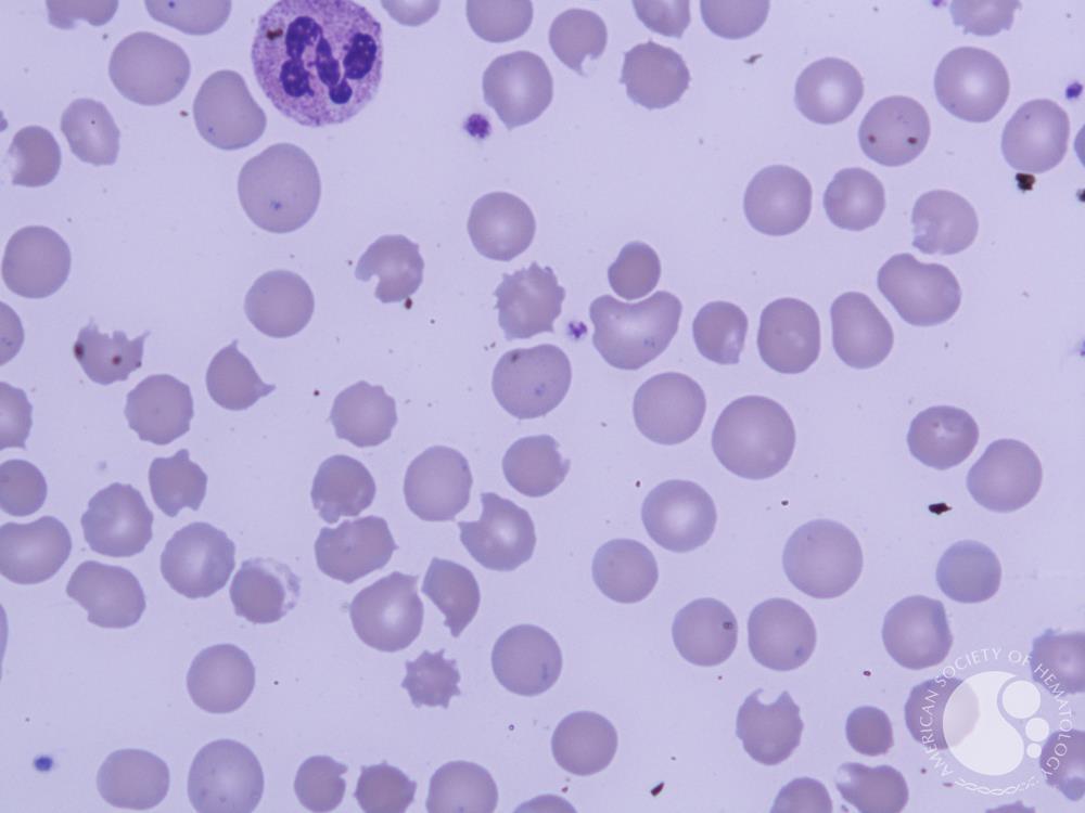 Leishman stain 100 X; Bite cells, Blister cells and toxic granulation in neutrophil