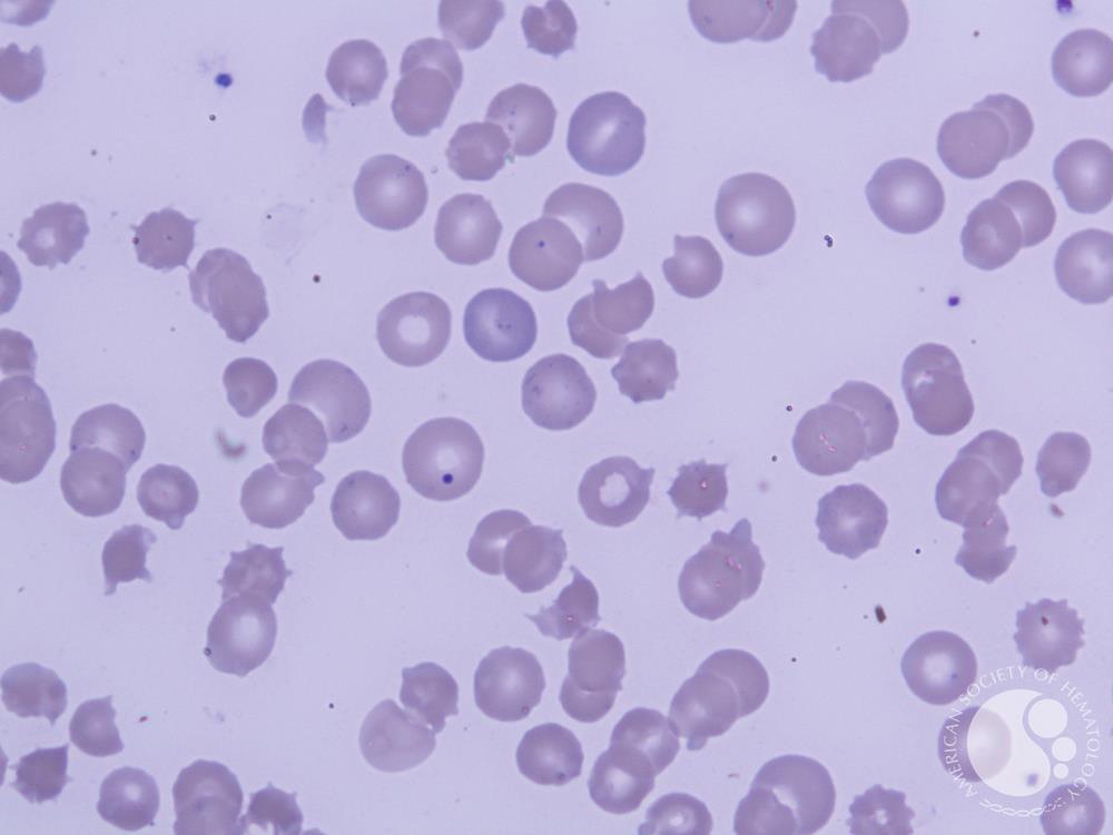 Leishman Stain 100X ; Howell Jolly bodies , Basophilic stippling , Bite cells, Polychromatophils