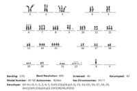 ACUTE MYELOID LEUKEMIA WITH BCR ABL TRANSLOCATION