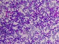 Peripheral smear showing absolute lymphocytosis