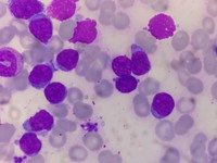 Bone marrow aspirate smear in high power showing mature lymphoid cells