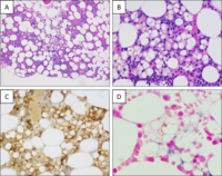 Bone marrow panniculitis in Sjogren syndrome