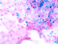 Figure 6. Bone marrow aspirate smear 100X, Perl’s stain showing ringed sideroblasts