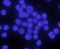 Figure7. Interphase FISH shows one orange signal indicative of 20q deletion in 89% of the nuclei scored and one normal cell showing 2 orange signals under 63x objective.