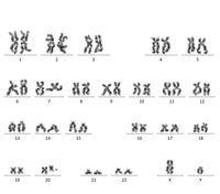 Figure 8. Bone marrow Karyotype with 46, XY,del(20)(q11.2) in all the 20 metaphases