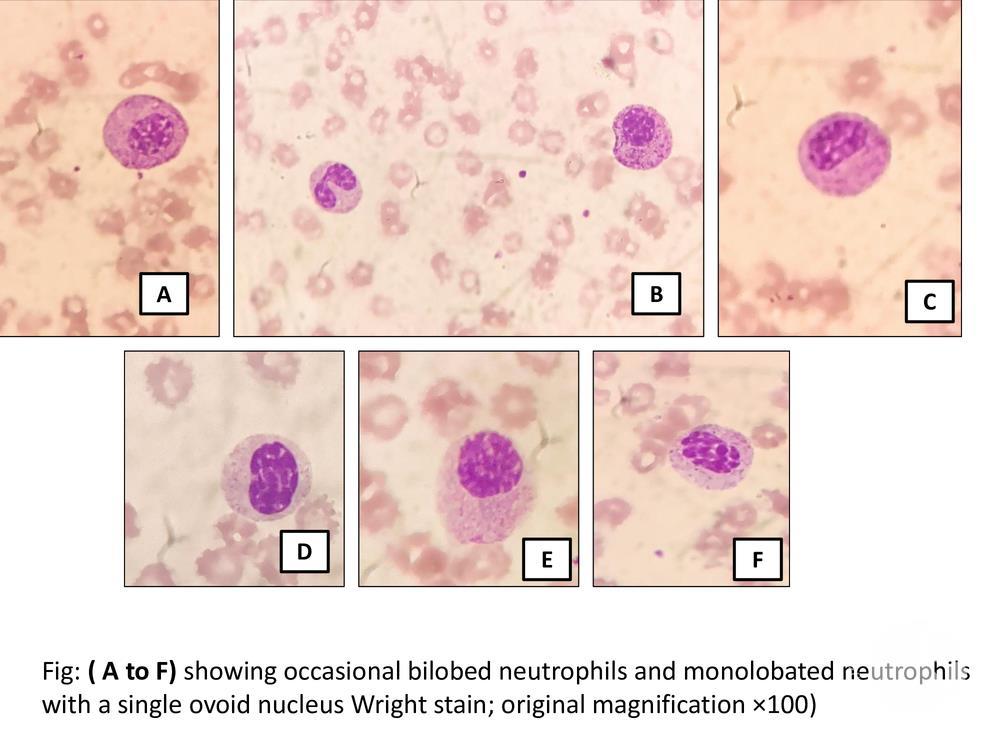 Pseudo-Pelger-Huet anomaly occurring with the use of mycophenolate mofetil and ganciclovir following renal transplantation.