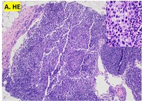 H&E showing large atypical cells