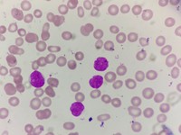 peripheral smear showing atypical lymphoid cells