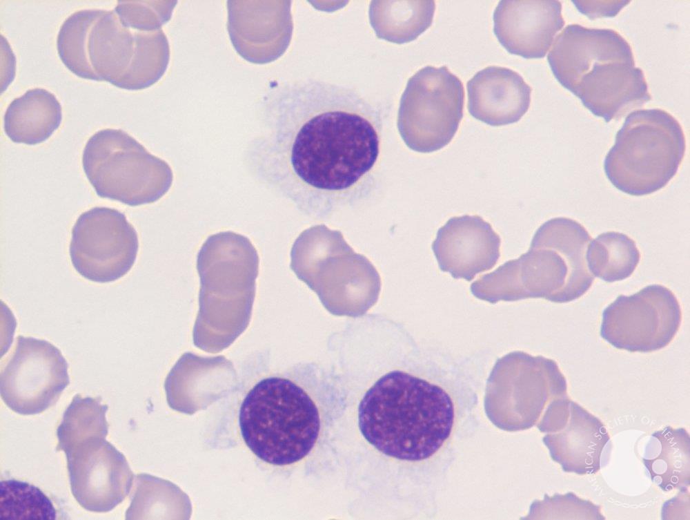 Hairy cell leukemia
