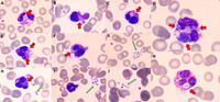 Phagocytosed klebsiella pneumoniae in peripheral blood smear