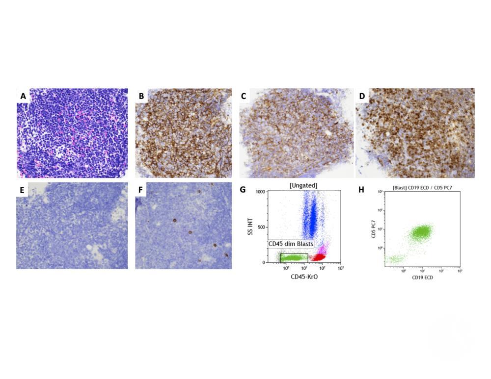 B-cell lymphoblastic leukemia with aberrant expression of CD5