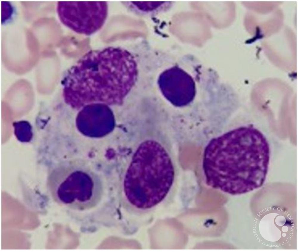 Hemophagocytosis