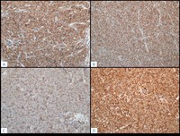 T-Lymphoblastic Lymphoma - Additional IHC