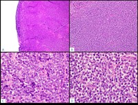 T-Lymphoblastic Lymphoma H&E