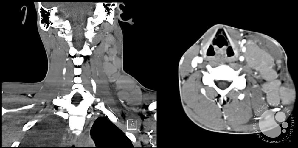 T-Lymphoblastic Lymphoma CT scan