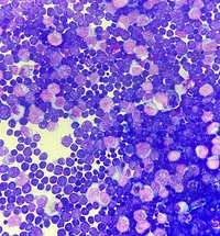 Pleural fluid lymphoma spill over