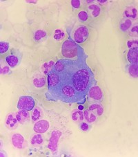 Dysplastic multinucleated plasma cell