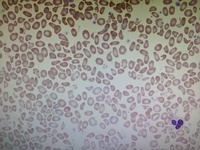 Hereditary Pyropoikilocytosis (SPTA1 Gene Pathologic Variant)