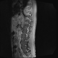 Granulocytic sarcoma