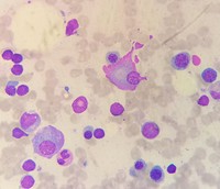 Flame cell (plasma cell myeloma