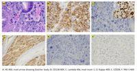 Plasma Cell Myeloma in the Stomach