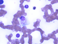 Figure A. Bone Marrow Aspirate Smear, 100X, Giemsa stain showing plasma cell with Auer rods like inclusion