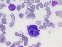 Hemophagocytic Lymphohistiocytosis 2