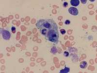 Hemophagocytic lymphohistiocytosis