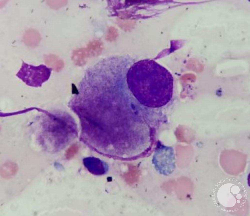Megakaryocyte in MDS with isolated del (5q)