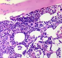 Megakaryocytes in MDS with isolated del (5q) 1