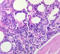 Megakaryocytes in MDS with isolated del (5q) 2