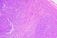 Hematoxylin body - Lupus lymphadenopathy 1