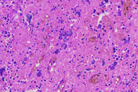 Hematoxylin body - Lupus lymphadenopathy 2