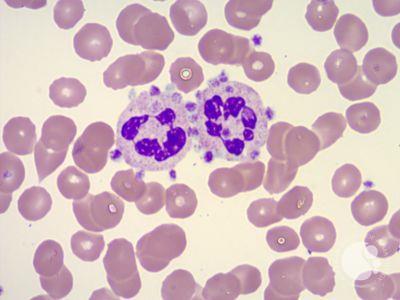 Photomicrographs from a Peripheral Blood Smear
