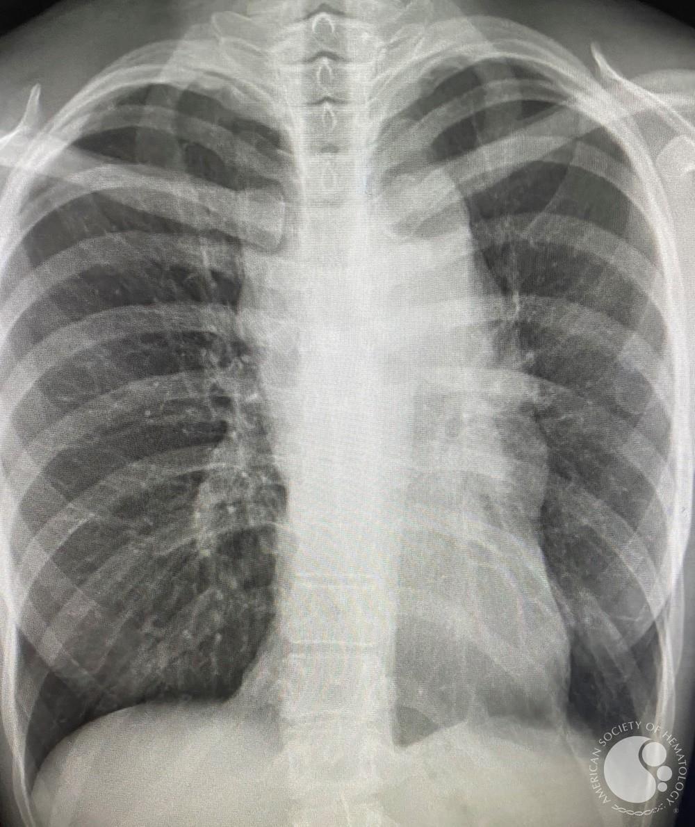 T-ALL chest X-ray