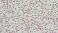 Drug-induced acanthocytosis 2