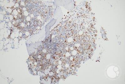 Panel-C, 10X: Pancytokeratin (AE1/AE3) positive staining in the epitheloid cells
