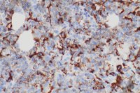 Panel-F, 40X: Higher power image of CD163 showing positive membranous staining