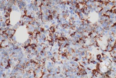 Panel-F, 40X: Higher power image of CD163 showing positive membranous staining
