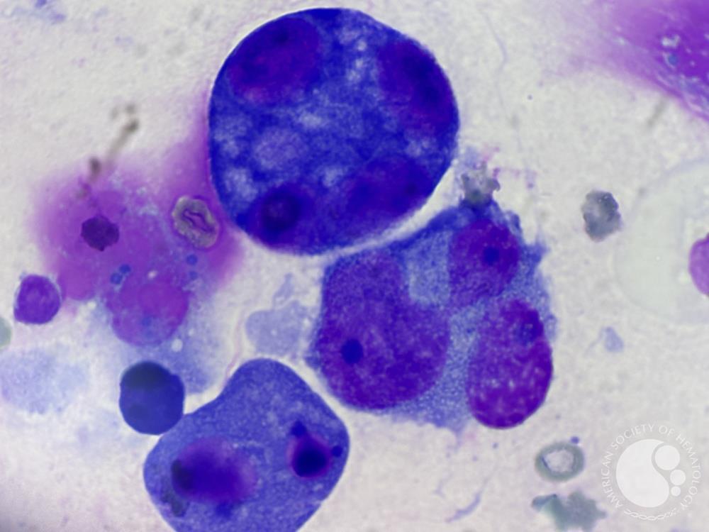 infiltrated plasma cell in pleural fluid 1