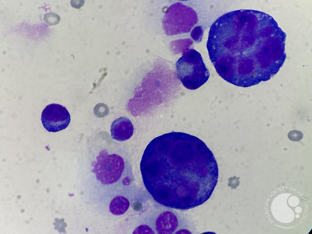 infiltrated plasma cell in pleural fluid 2