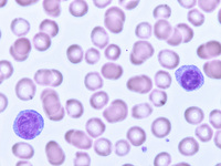 Waldenstrom's macroglobulinemia-PB 1