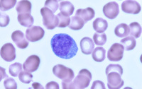 Waldenstrom's macroglobulinemia-PB 3