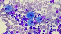 Pseudo-Gaucher cells in beta thalassemia