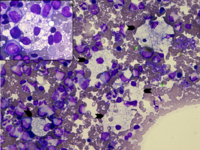 Morphology of Niemann-Pick type A metabolic storage disorder