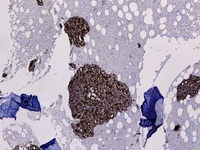 Immunohistochemistry for Prostate specific antigen positive