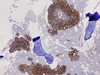 Immunohistochemistry for NKX3.1 positive