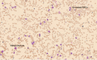 Peripheral blood smear with too many NRBCs 1