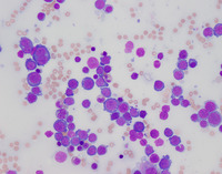 Bone marrow aspirate 1