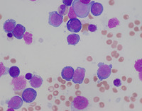 Bone marrow aspirate 2